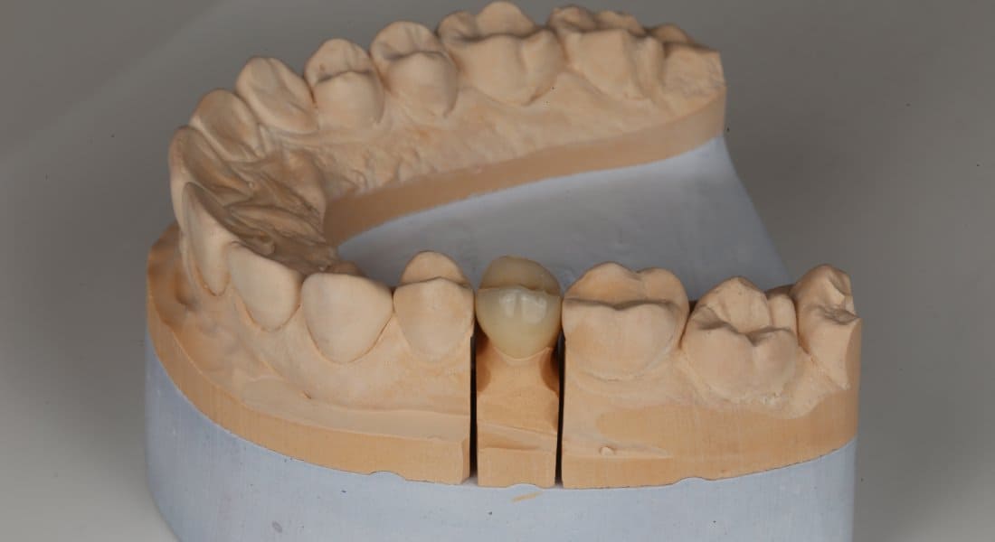 Root canal treated posterior tooth with structural damage - treatment ...